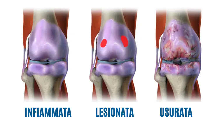 cartilagine del ginocchio