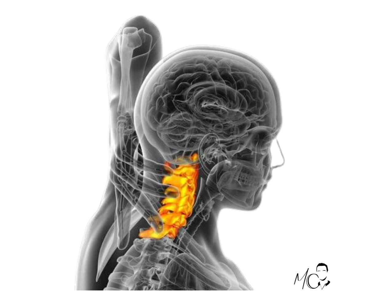 artrosi cervicale
